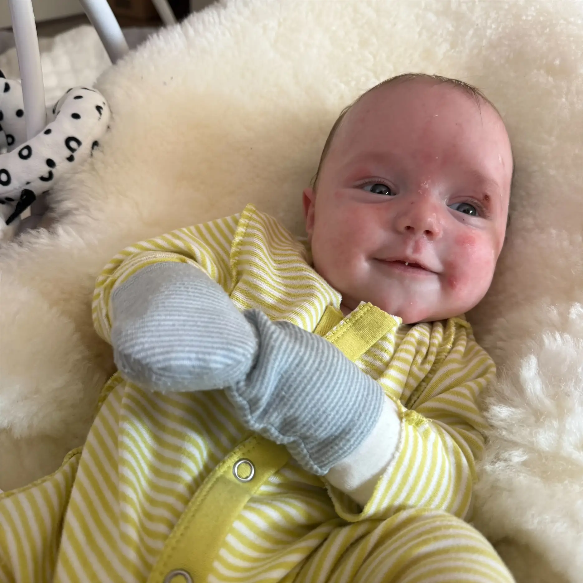 Mom's Agony as Heartbreaking Butterfly Skin Condition Stops Her Holding Her Baby
