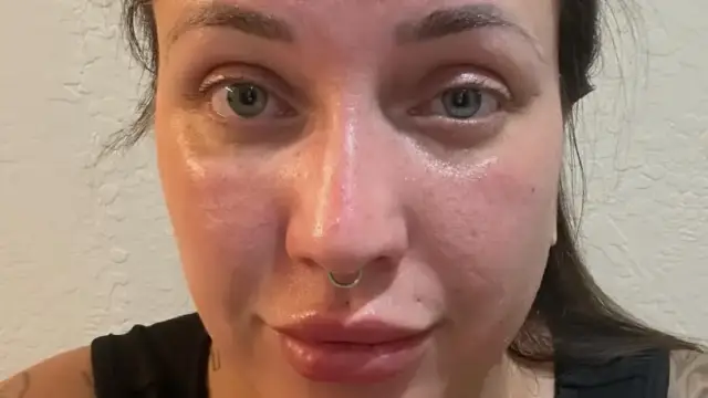 Woman Reveals Stunning Facial Transformation After Seven Years of Alcohol Abuse